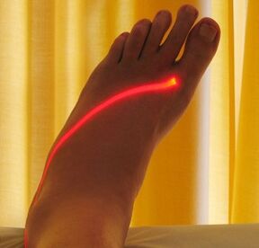 laserová léčba křečových žil na nohou
