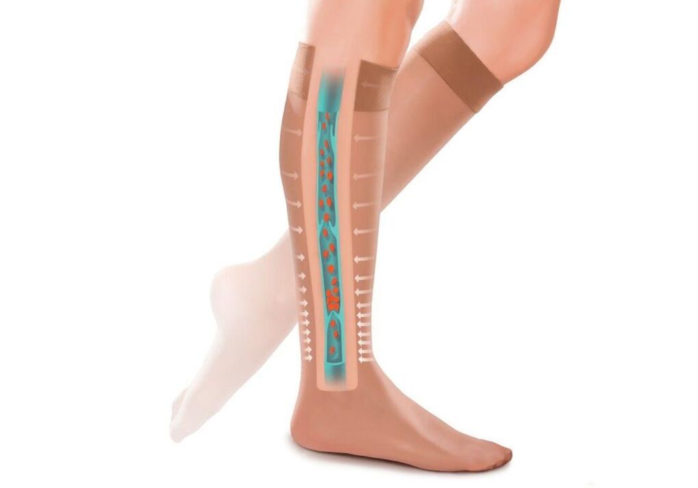 účinek kompresních punčoch na nohou s křečovými žilami