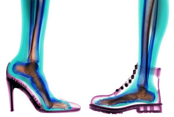 pohodlné a nepohodlné boty pro prevenci křečových žil