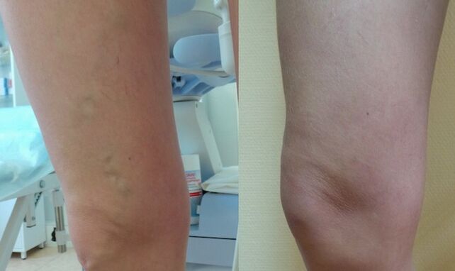 noha před a po léčbě retikulárních křečových žil