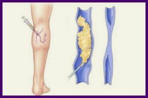 Skleroterapie je oblíbená metoda, jak se zbavit křečových žil na nohou