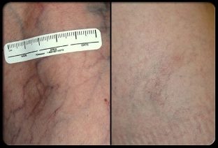 Před a po proceduře laserové terapie