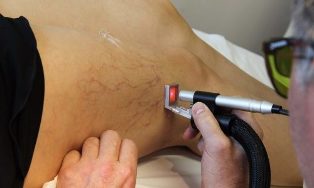léčba křečové žíly laserem